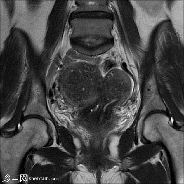 双子宫局灶性子宫腺肌病伴平滑肌瘤