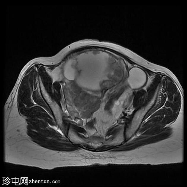 附件多房肿块（O-RADS MRI 4）