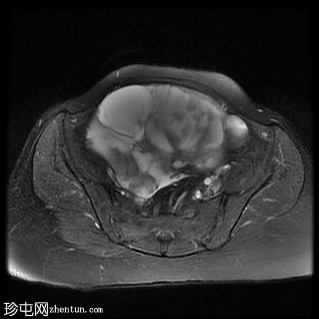 附件多房肿块（O-RADS MRI 4）