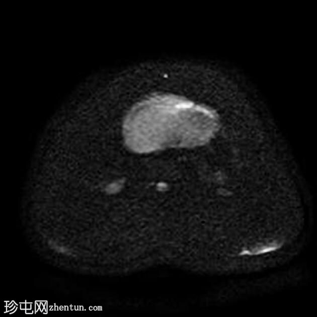 附件多房肿块（O-RADS MRI 4）