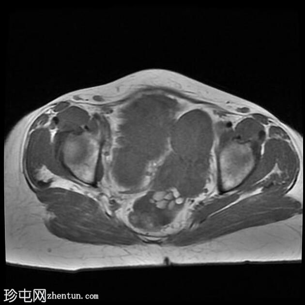 附件多房肿块（O-RADS MRI 4）