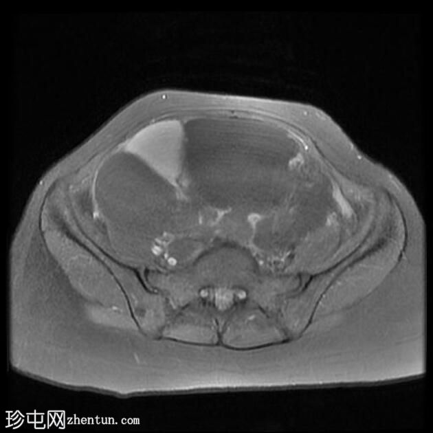 附件多房肿块（O-RADS MRI 4）