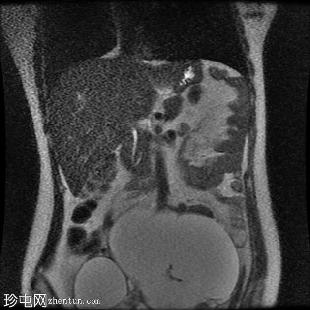 附件多房肿块（O-RADS MRI 4）