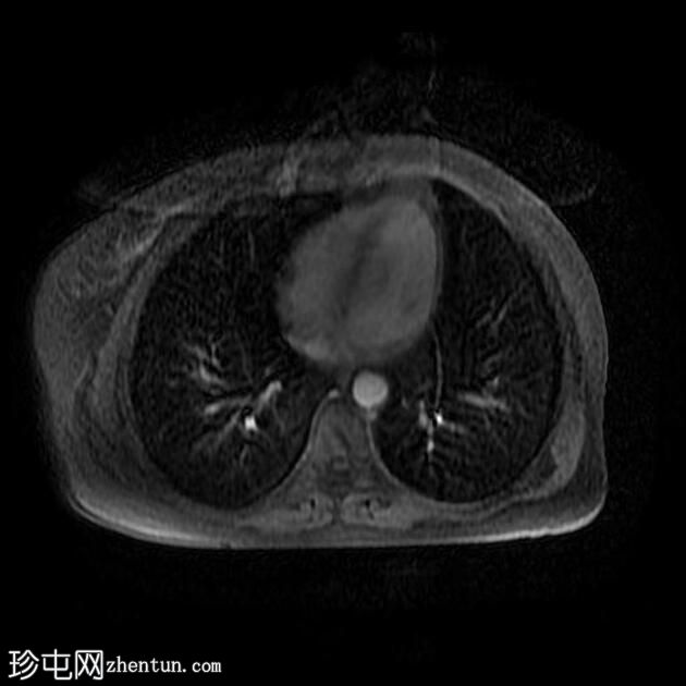 附件多房肿块（O-RADS MRI 4）