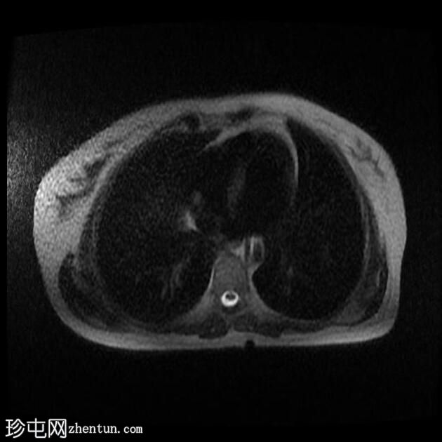 附件多房肿块（O-RADS MRI 4）