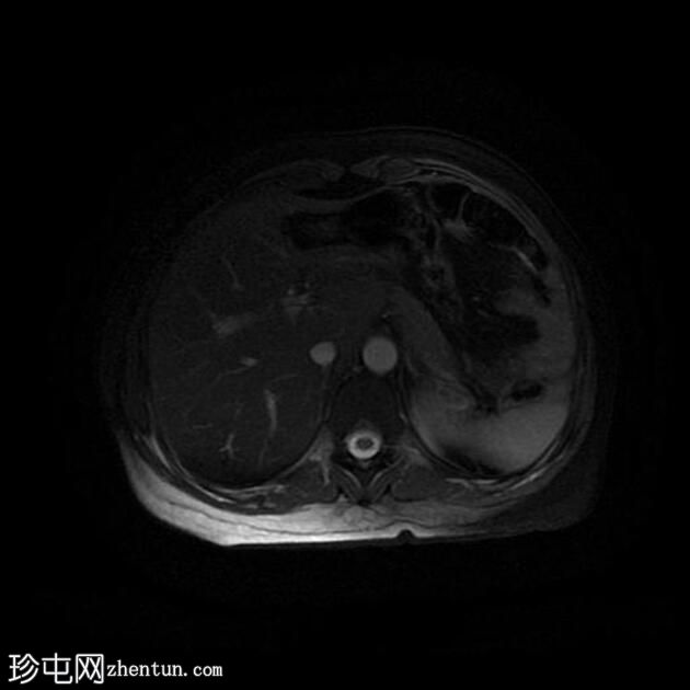 附件多房肿块（O-RADS MRI 4）