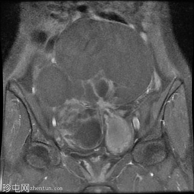 附件多房肿块（O-RADS MRI 4）