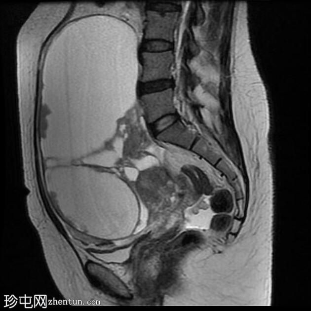 附件多房肿块（O-RADS MRI 4）