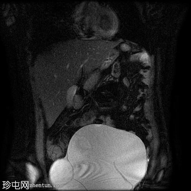 附件多房肿块（O-RADS MRI 4）