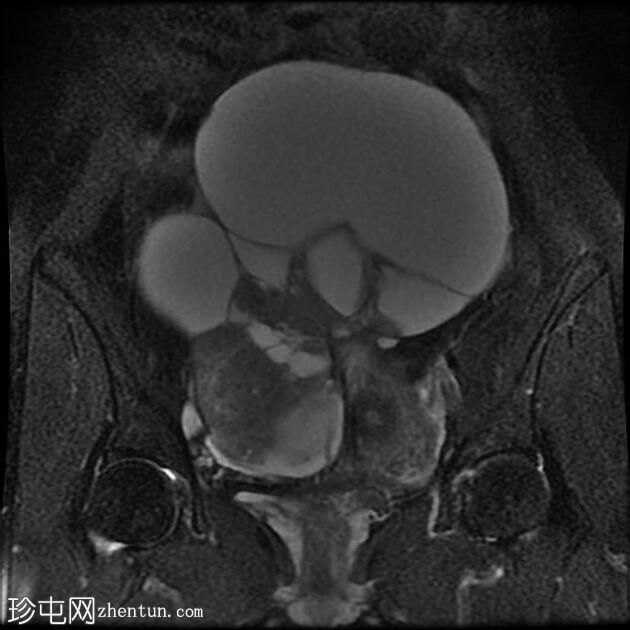 附件多房肿块（O-RADS MRI 4）