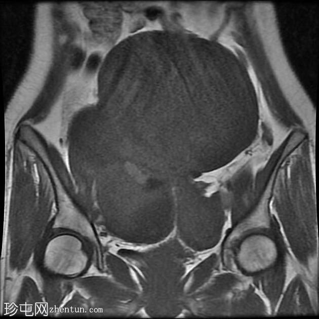 附件多房肿块（O-RADS MRI 4）