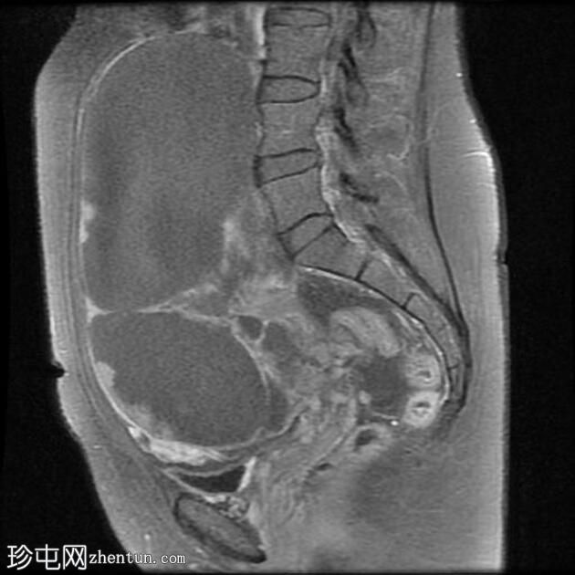 附件多房肿块（O-RADS MRI 4）