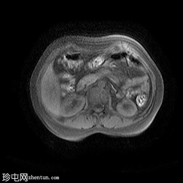 附件多房肿块（O-RADS MRI 4）