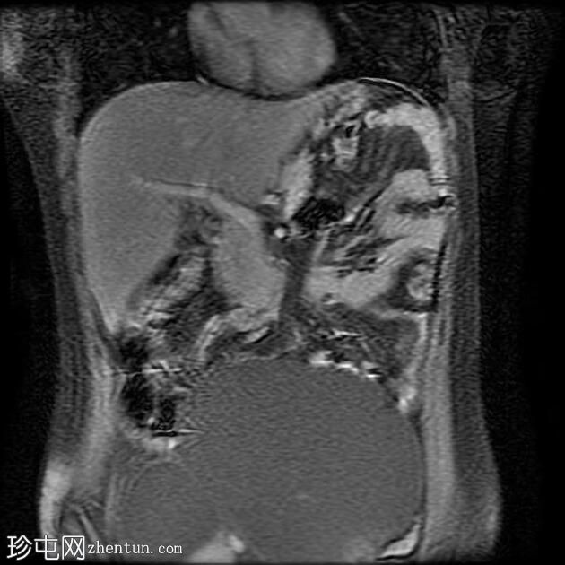 附件多房肿块（O-RADS MRI 4）