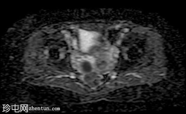 卵巢成人颗粒细胞瘤伴对侧卵巢纤维瘤