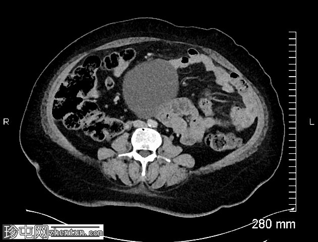 卵巢浆液性交界性肿瘤 (SMBT) 和浆液性囊腺瘤
