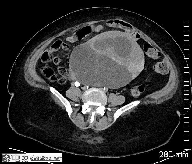 卵巢浆液性交界性肿瘤 (SMBT) 和浆液性囊腺瘤