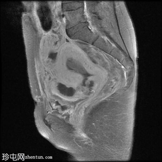 子宫缝合裂开和脓肿形成