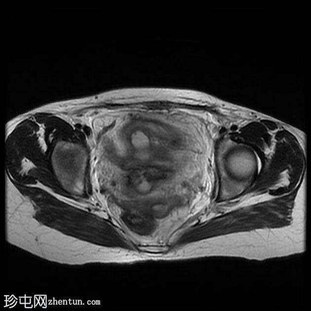 子宫缝合裂开和脓肿形成