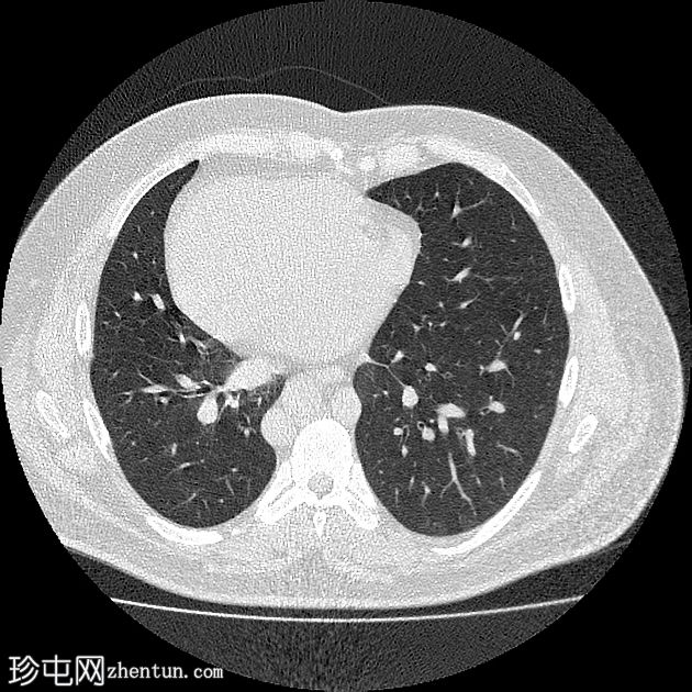 左侧异位症（多脾综合征）