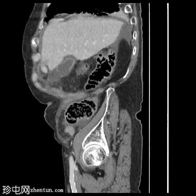 胆囊穿孔合并胆汁性腹膜炎