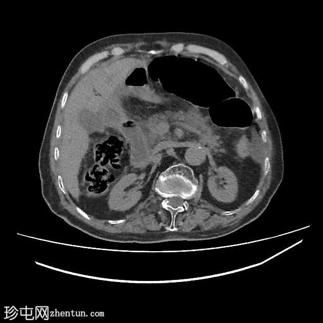 胆囊穿孔合并胆汁性腹膜炎