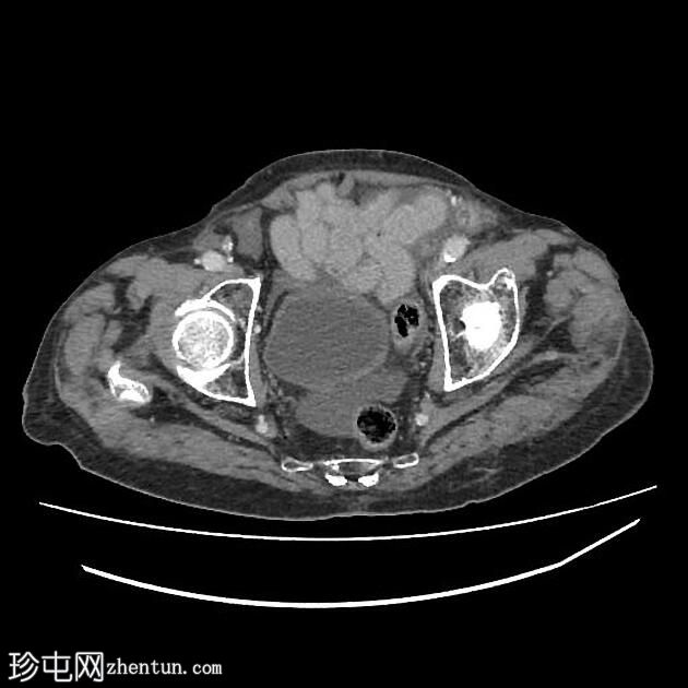 胆囊穿孔合并胆汁性腹膜炎