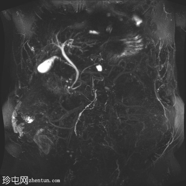 胆结石脱落引起的异物肉芽肿