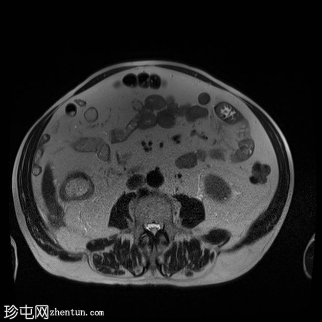 胆结石脱落引起的异物肉芽肿