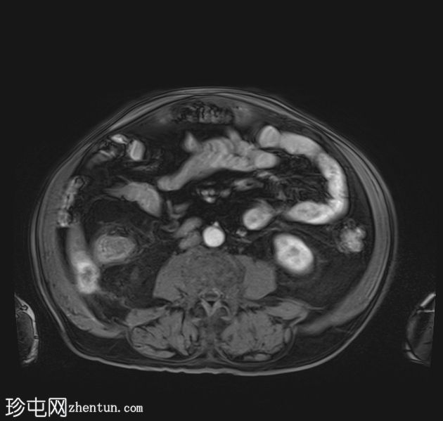 胆结石脱落引起的异物肉芽肿