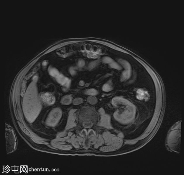 胆结石脱落引起的异物肉芽肿