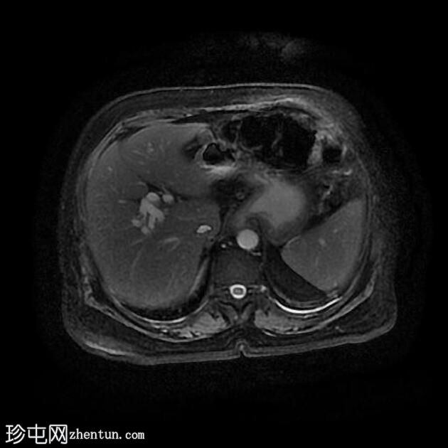 胆总管结石和胆石症 (MRCP)