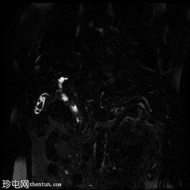 胆总管结石和胆石症 (MRCP)