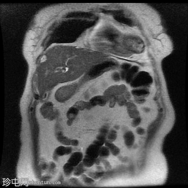 胆总管结石和胆石症 (MRCP)