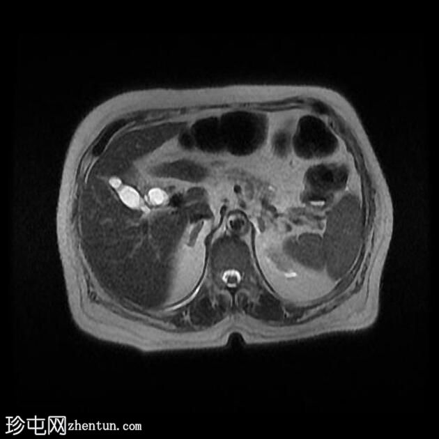 胆总管结石和胆石症 (MRCP)