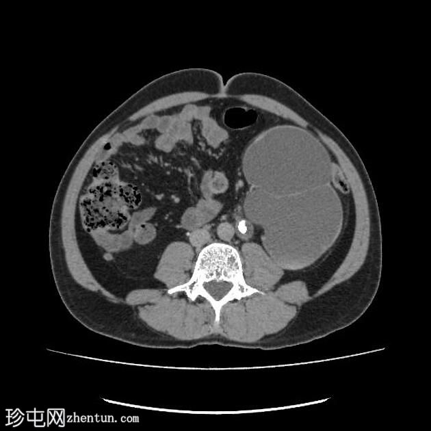 梗阻性尿路病