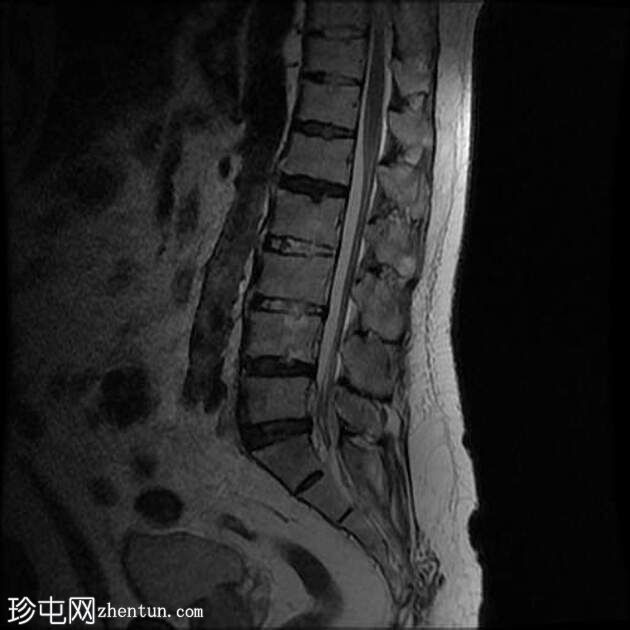 强直性脊柱炎