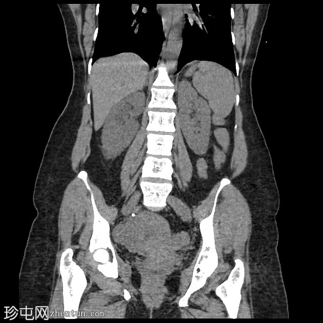 膀胱阴道瘘