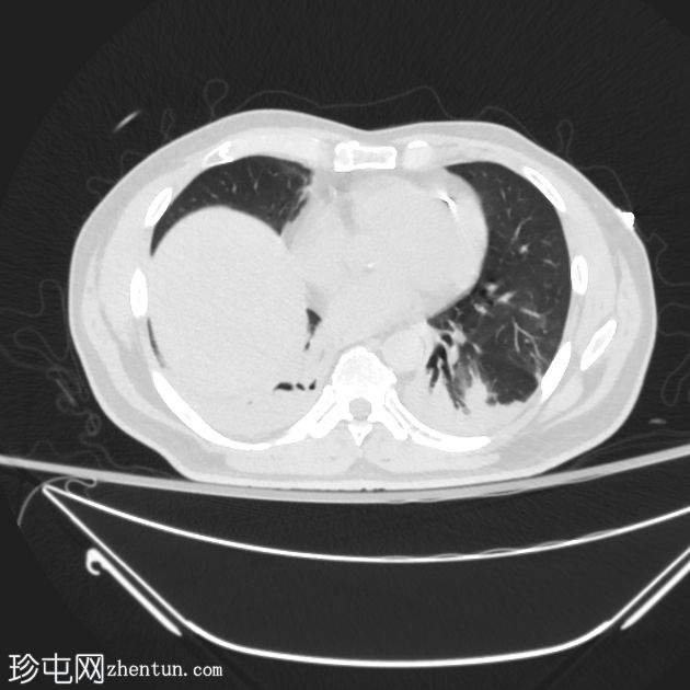 近距离放射治疗粒子迁移