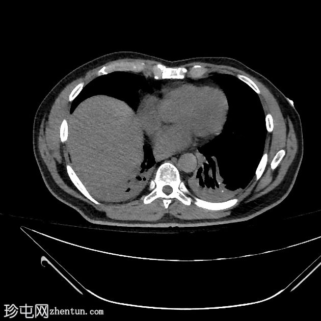 近距离放射治疗粒子迁移