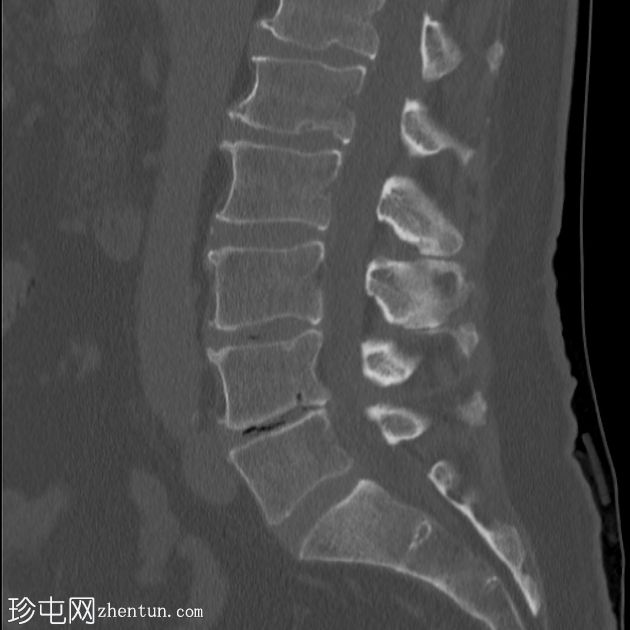 骶骨浆细胞瘤