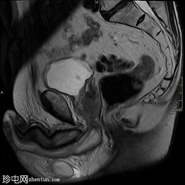 T3b 前列腺癌