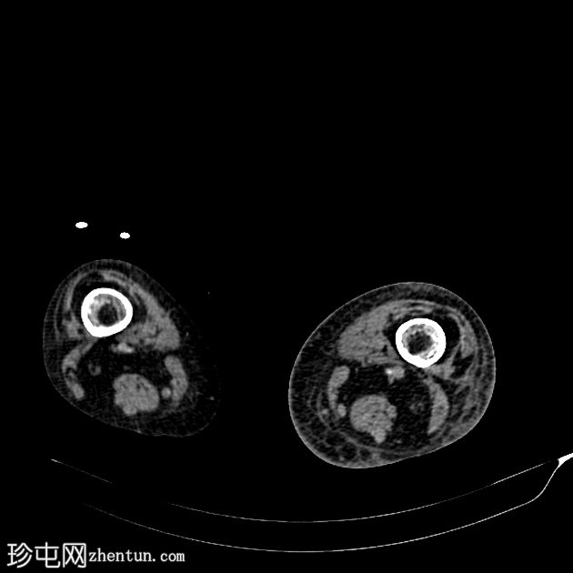 坏死性筋膜炎