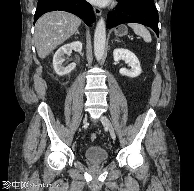 最近输尿管结石排出后漏尿