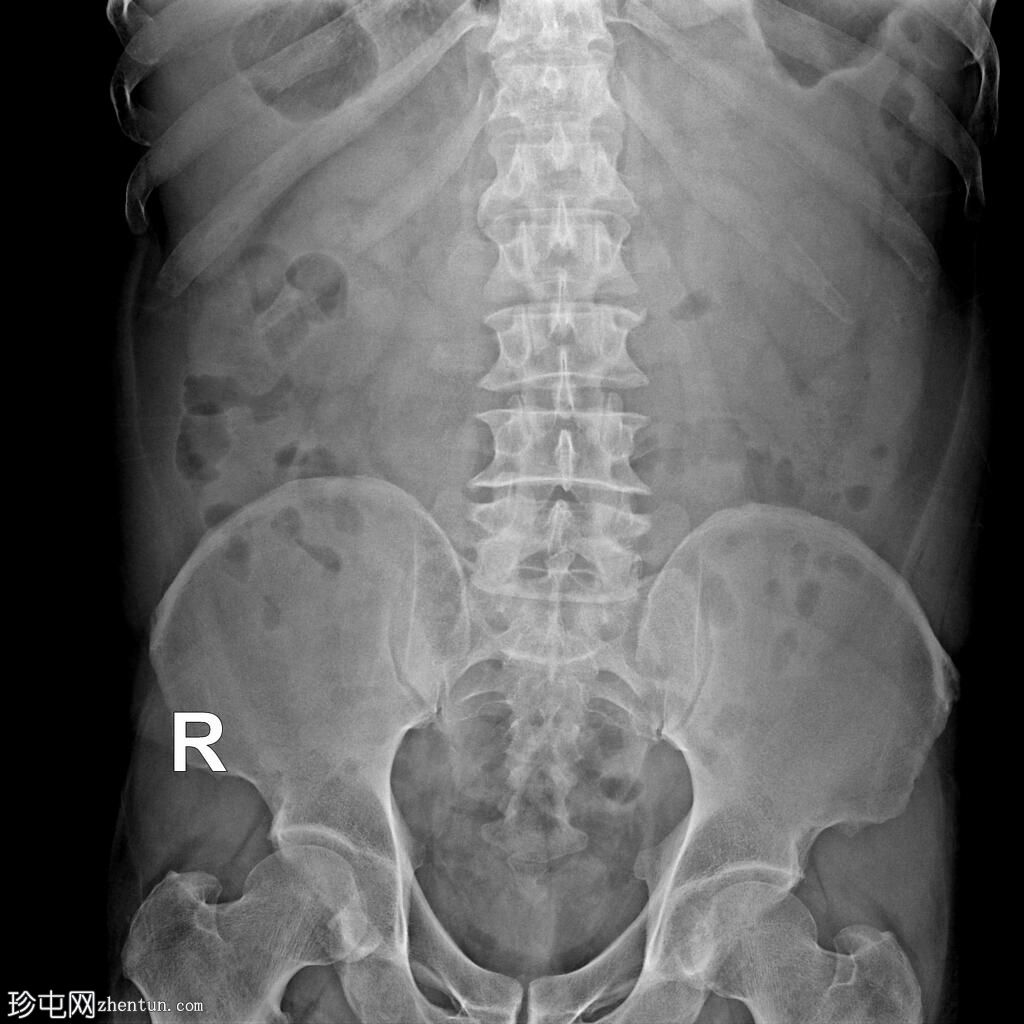 肾盂输尿管连接部梗阻