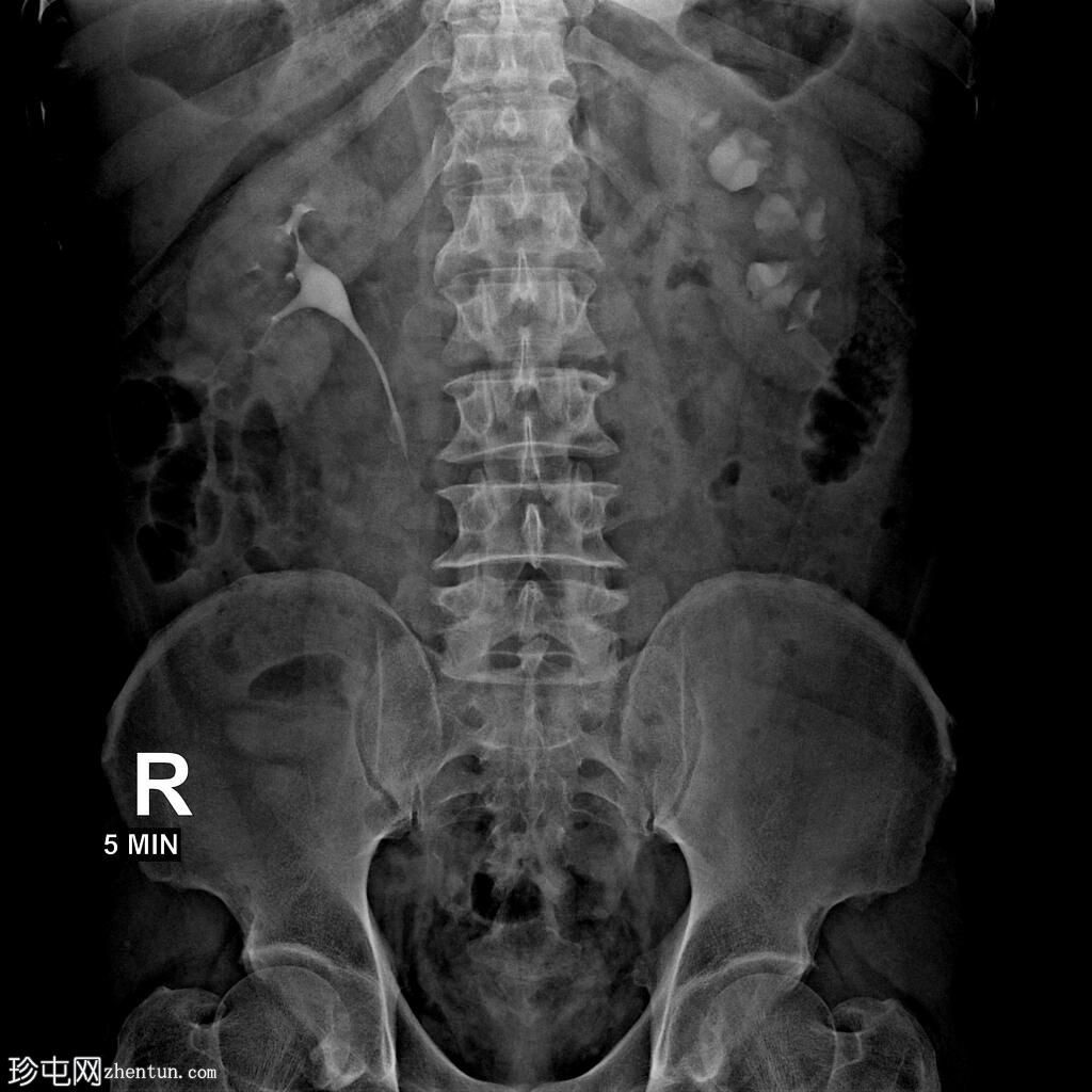 肾盂输尿管连接部梗阻