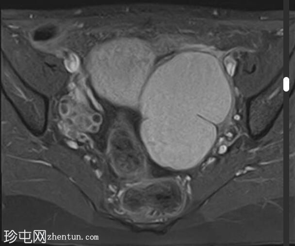 卵巢大子宫内膜瘤