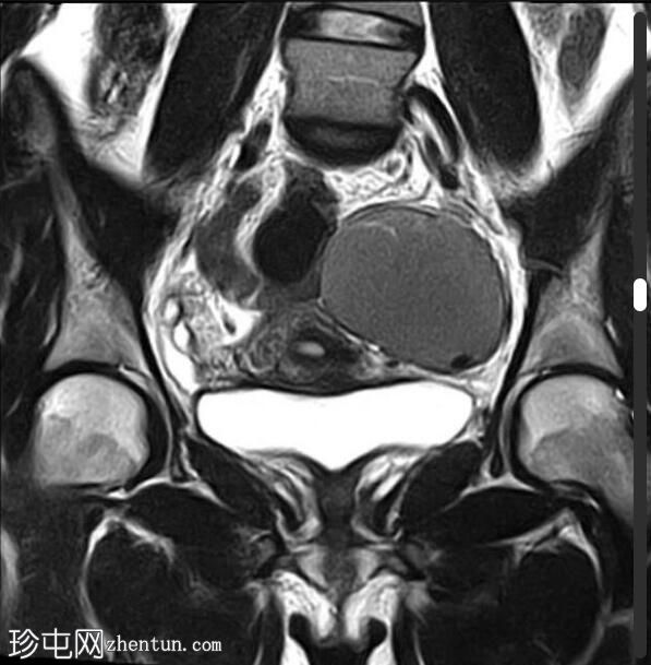 卵巢大子宫内膜瘤