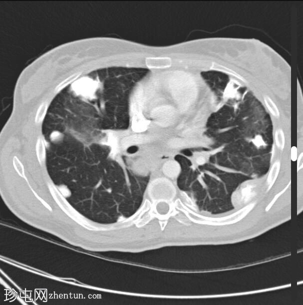骨肉瘤 - 肺转移