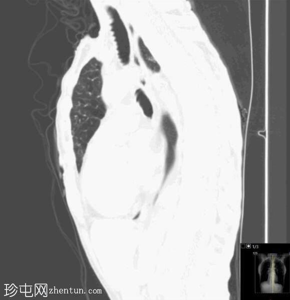 右中叶瘢痕性肺不张